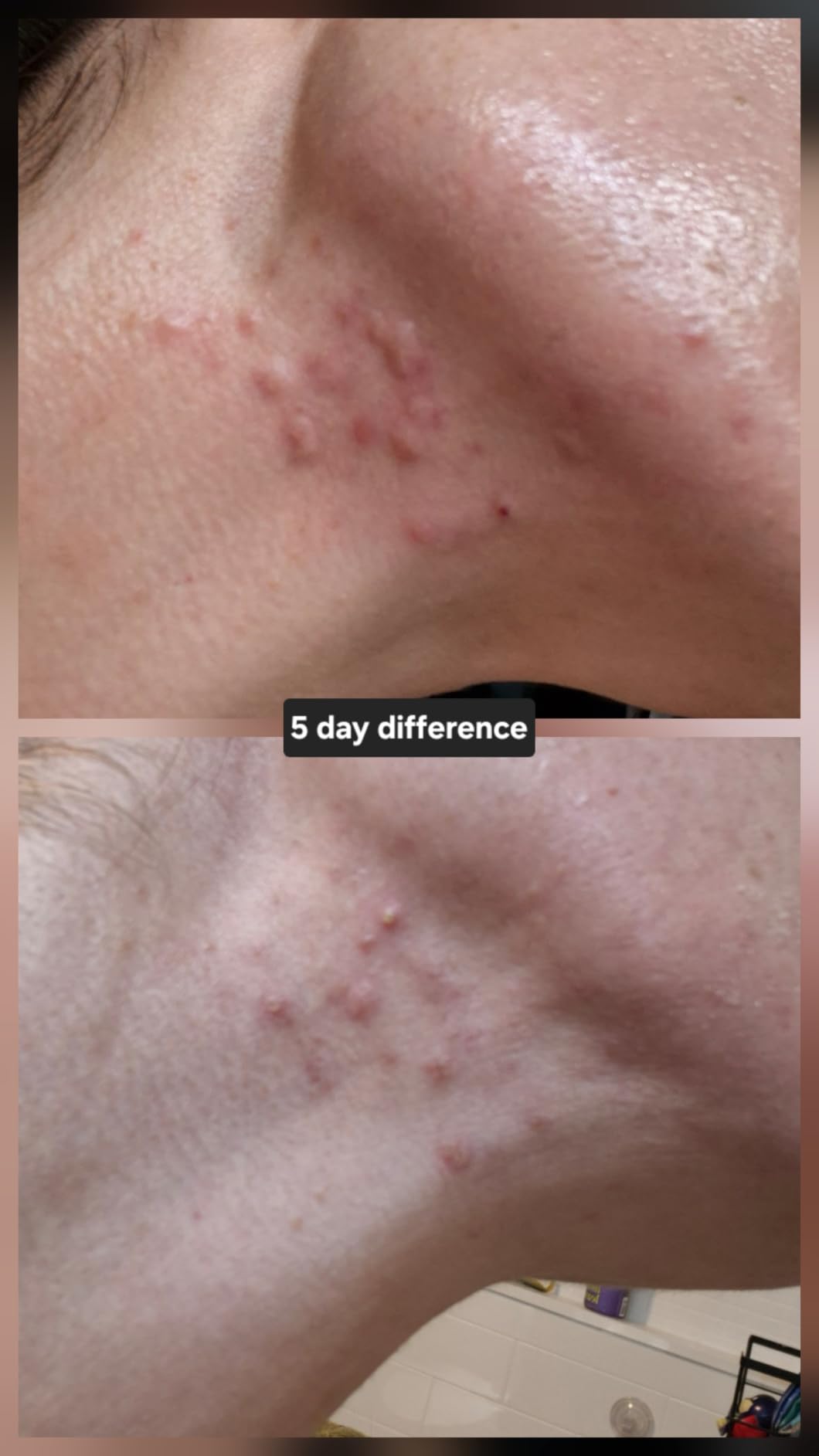 The Ordinary Salicylic Acid 2% Solution, Acne-Fighting Serum for Blemish-Prone Skin, 30ml view 6