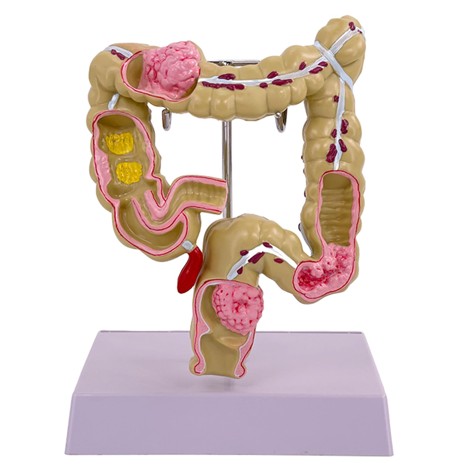 Modello umano dell'intestino crasso Patologie umane del modello dell'intestino crasso Strumento didattico per studi scolastici di laboratorio Patologie del modello dell'intestino crasso Modello di