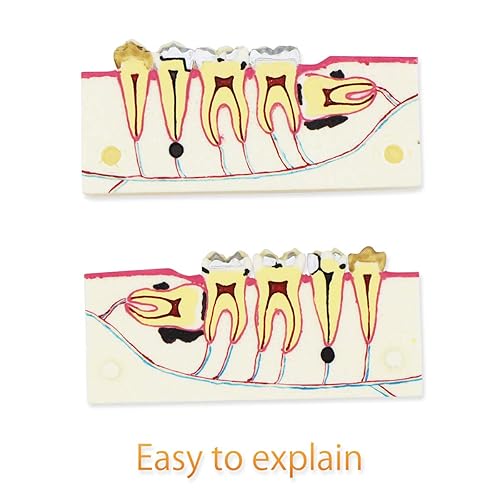 Miniatura 4 de Modelo de Dientes Dentales D-WD,Modelo de Dientes de Implante Dentales Transparente Dentista Enfermedad Estándar Desmontable Diente Patológico