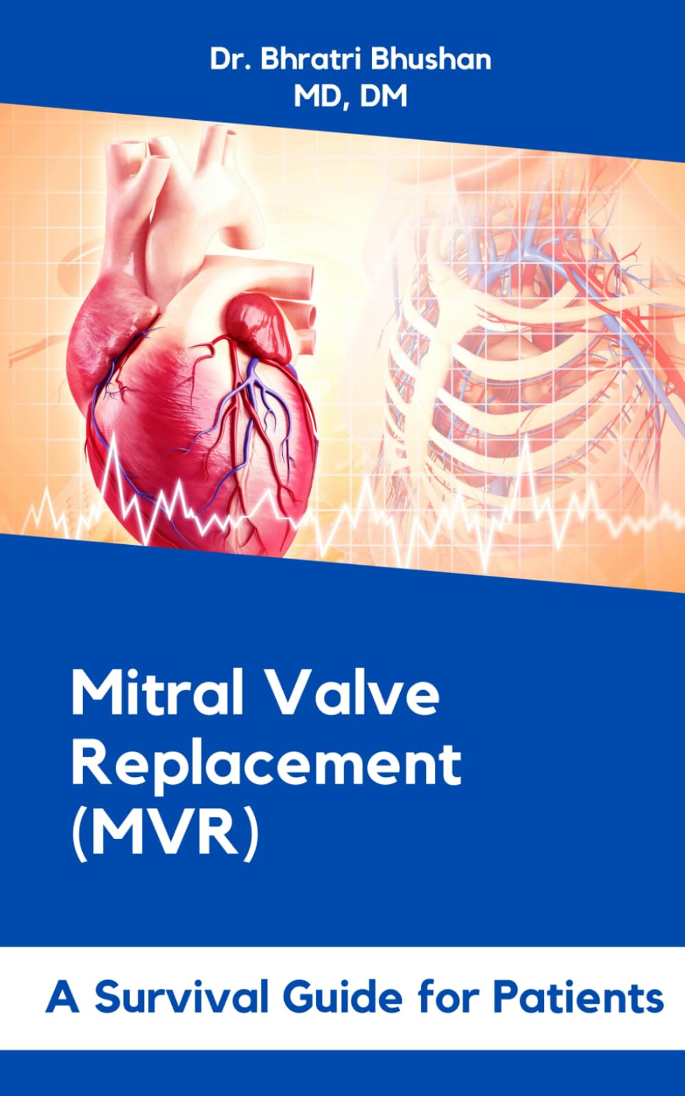 Mitral Valve Replacement (MVR): A Survival Guide for Patients