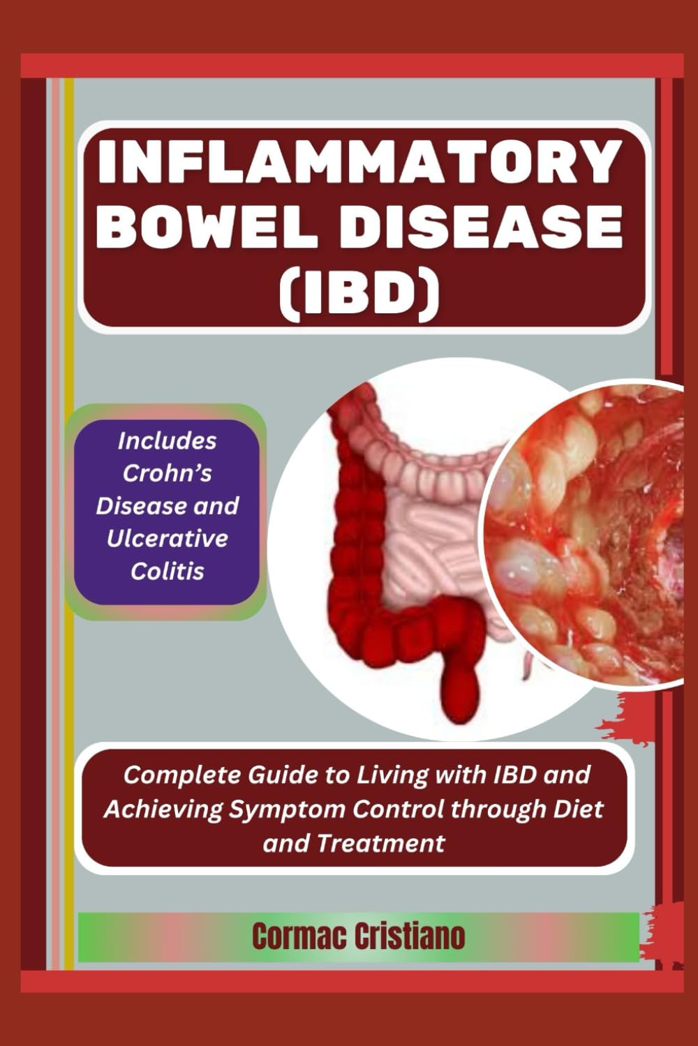 INFLAMMATORY BOWEL DISEASE (IBD): Includes Crohn’s Disease and Ulcerative Colitis: Complete Guide to Living with IBD and Achieving Symptom Control through Diet and Treatment