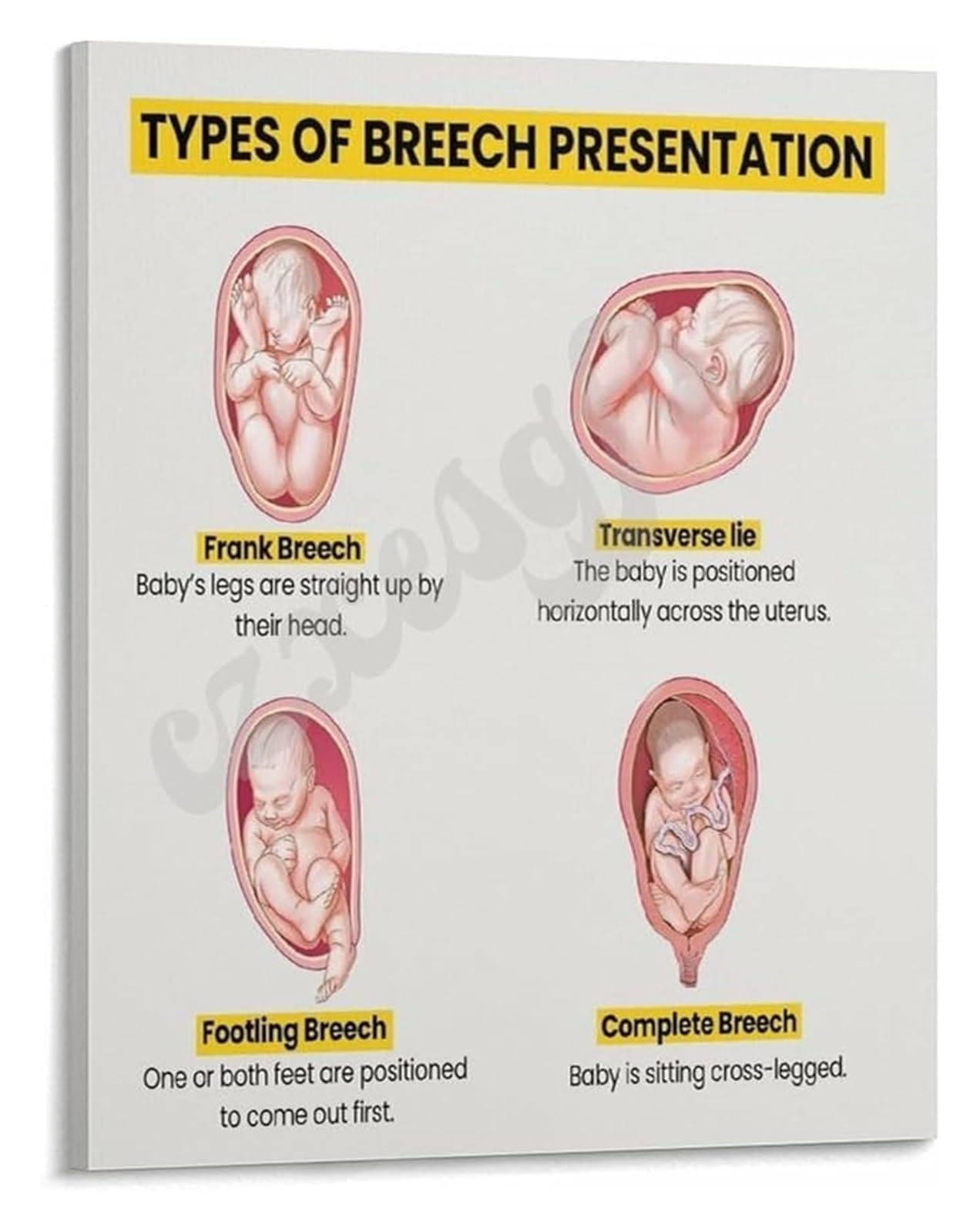 IDGTTLDF Breech Fetal Positions Poster Diagnosis and Types Chart for Emergency Obstetrics and Training Programs Canvas Framed,16x24inch(40x60cm)