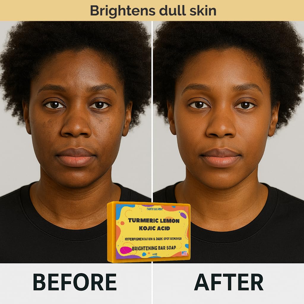 Vitamin C & Turmeric Face Exfoliating Clears Blackheads Improve Dark Spot Acne Dead Sea Minerals Green Tea Carrot Hyaluronic Acid + Kojic Acid (6 oz, Turmeric Face Cream and Bar Soap)