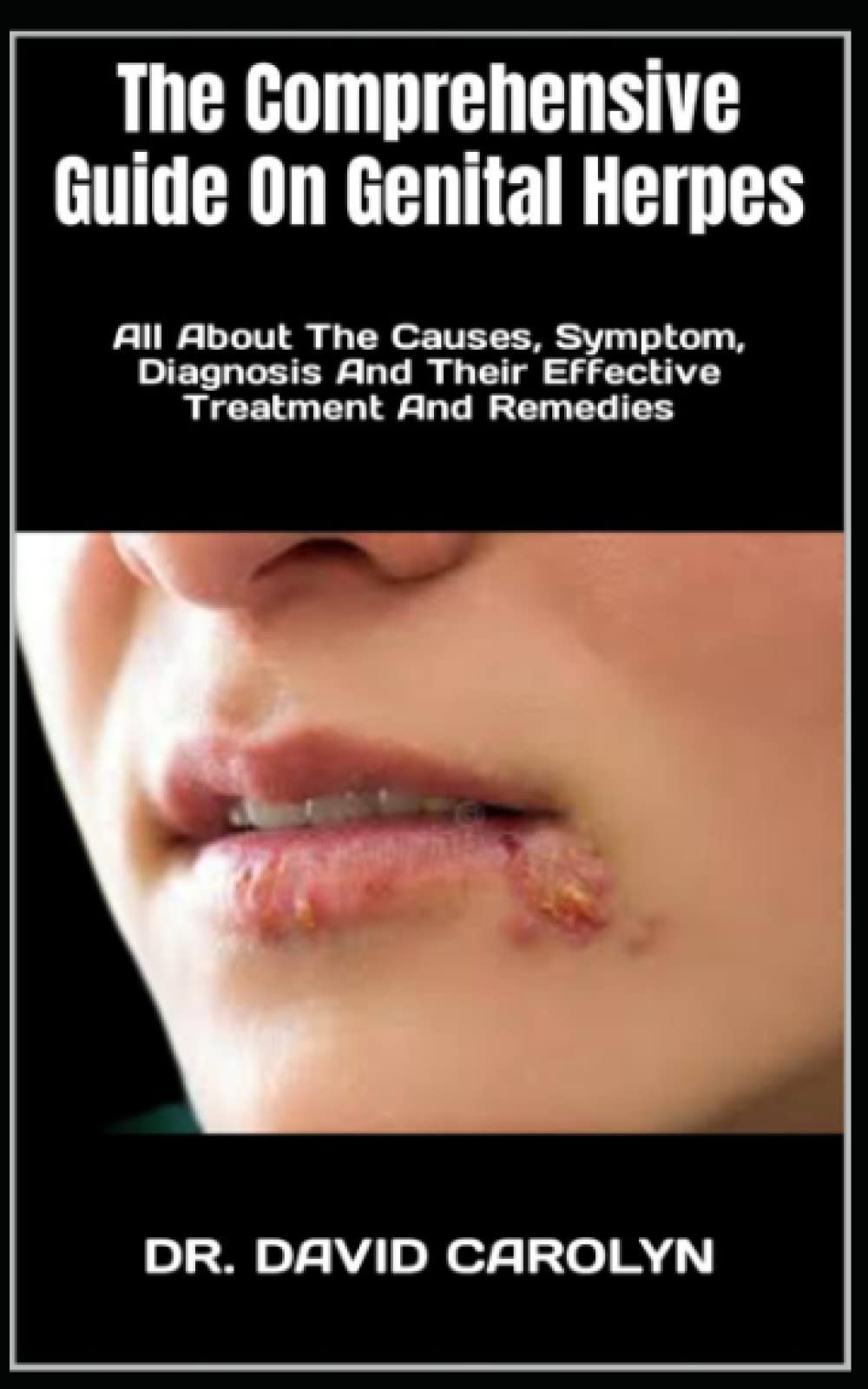 Buy The Comprehensive Guide On Genital Herpes All About The Causes