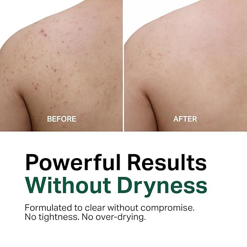 Miniatura 2 de Y'OUR Gel de baño para eliminar el acné  Fórmula de ácido salicílico suave y que no seca  Para uso en todo el cuerpo, suaviza la textura y unifica