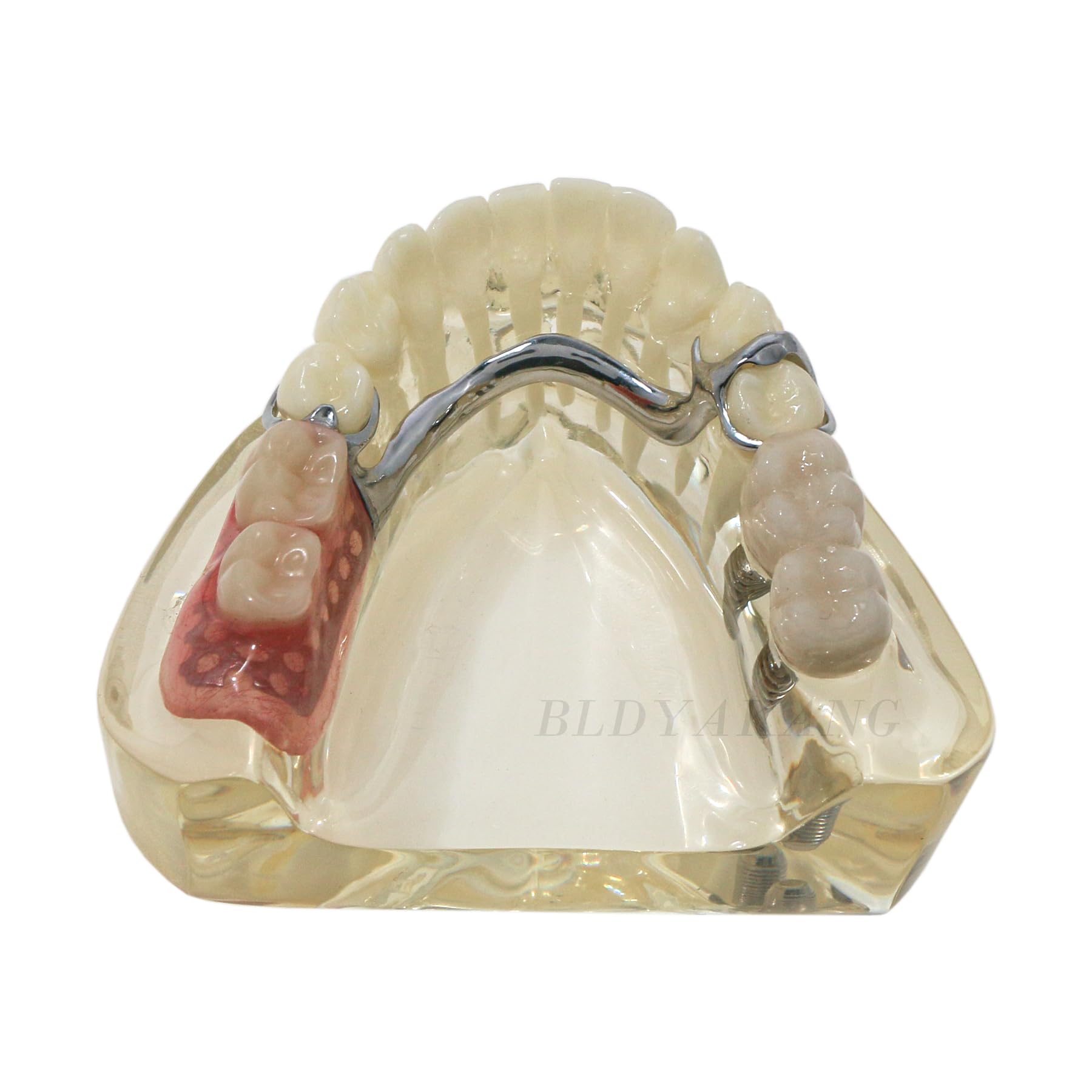 Dental Typodont lmplant Model RPD Removable Partial dentures Model Dental Typodont Restoration Teeth Model