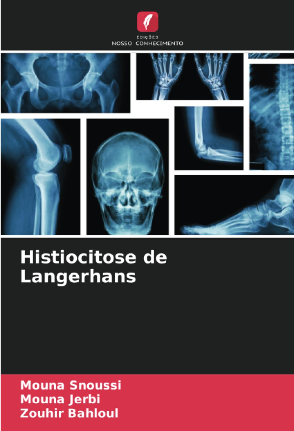 Histiocitose de Langerhans