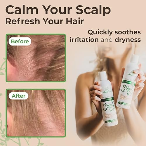 Miniatura 6 de Wild Naturals, Acondicionador calmante y nutritivo para cuero cabelludo seco, caspa, eczema, dermatitis seborreica, enrojecimiento y más, pH