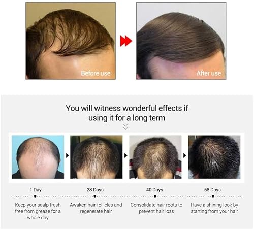 Best Natural Mkkenley Magic Hair Growth Tonic Ginseng Best Hair Loss Treatment For Men,Women Hair Grow Fast, Best Treatment For Bald Baldheaded, Nourish Scalp Hair Anti-Hair Loss, Hair Regrowth, Stop Hair Loss #TOP4