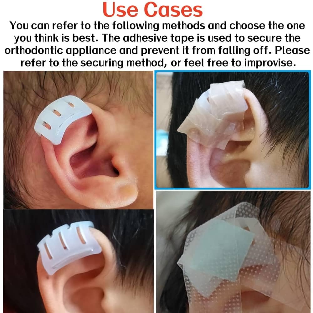 Infant Lop Ear Deformity Correction Clip For Newborn Baby Fixing Auricle Valgus Patch Stickers Children Ear Shape Aesthetic Corrector Without Surgery product thumbnail 5