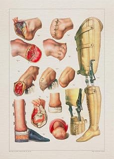 Anatomy TRANSTIBIAL PROSTHESIS AMPUTATION print SRA3 12x18 conqueror laid paper