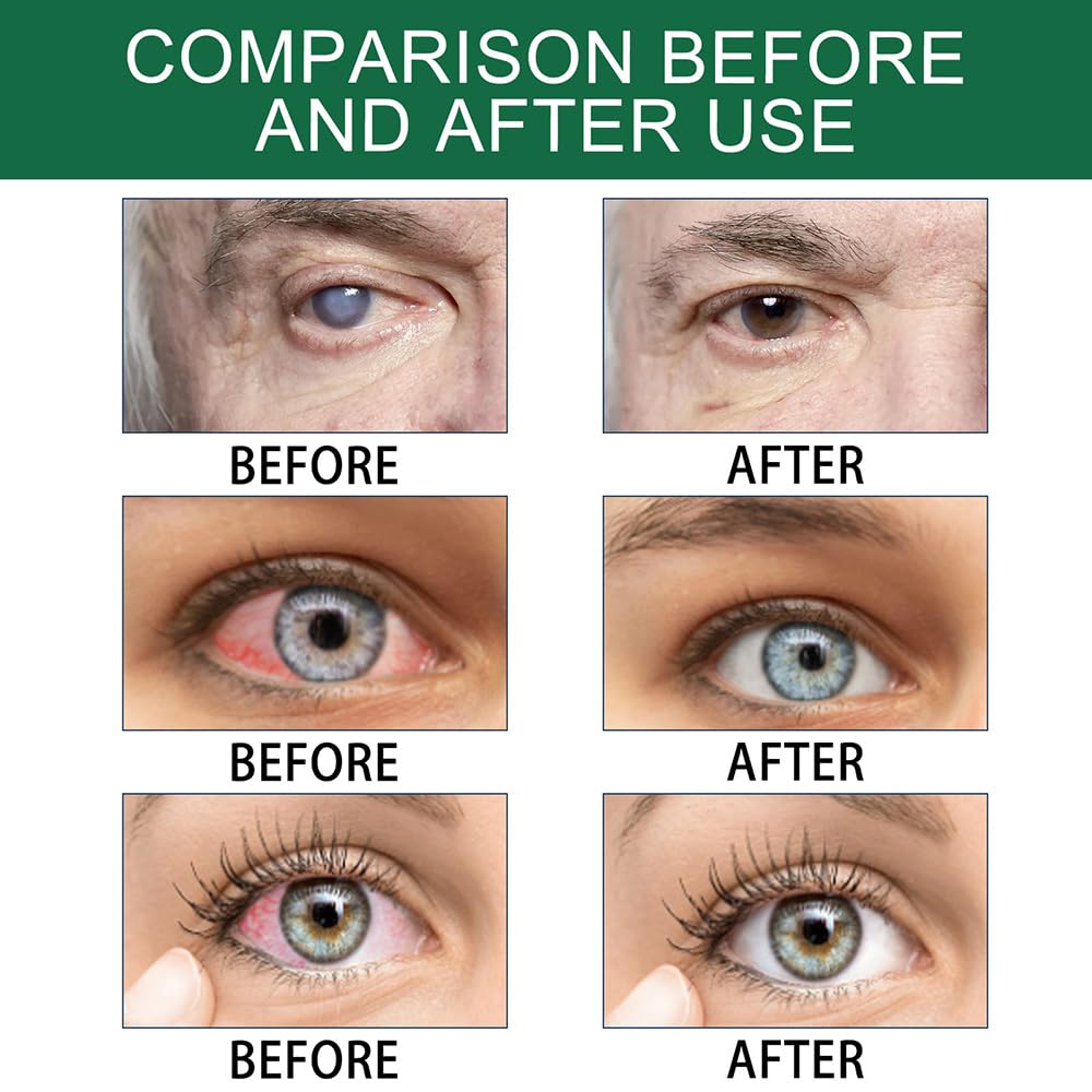Optivipro Presbicia Gotas para los ojos, gotas para los ojos Optivipro, gotas para los ojos de recuperación de la visión (3 cajas/30 unidades)