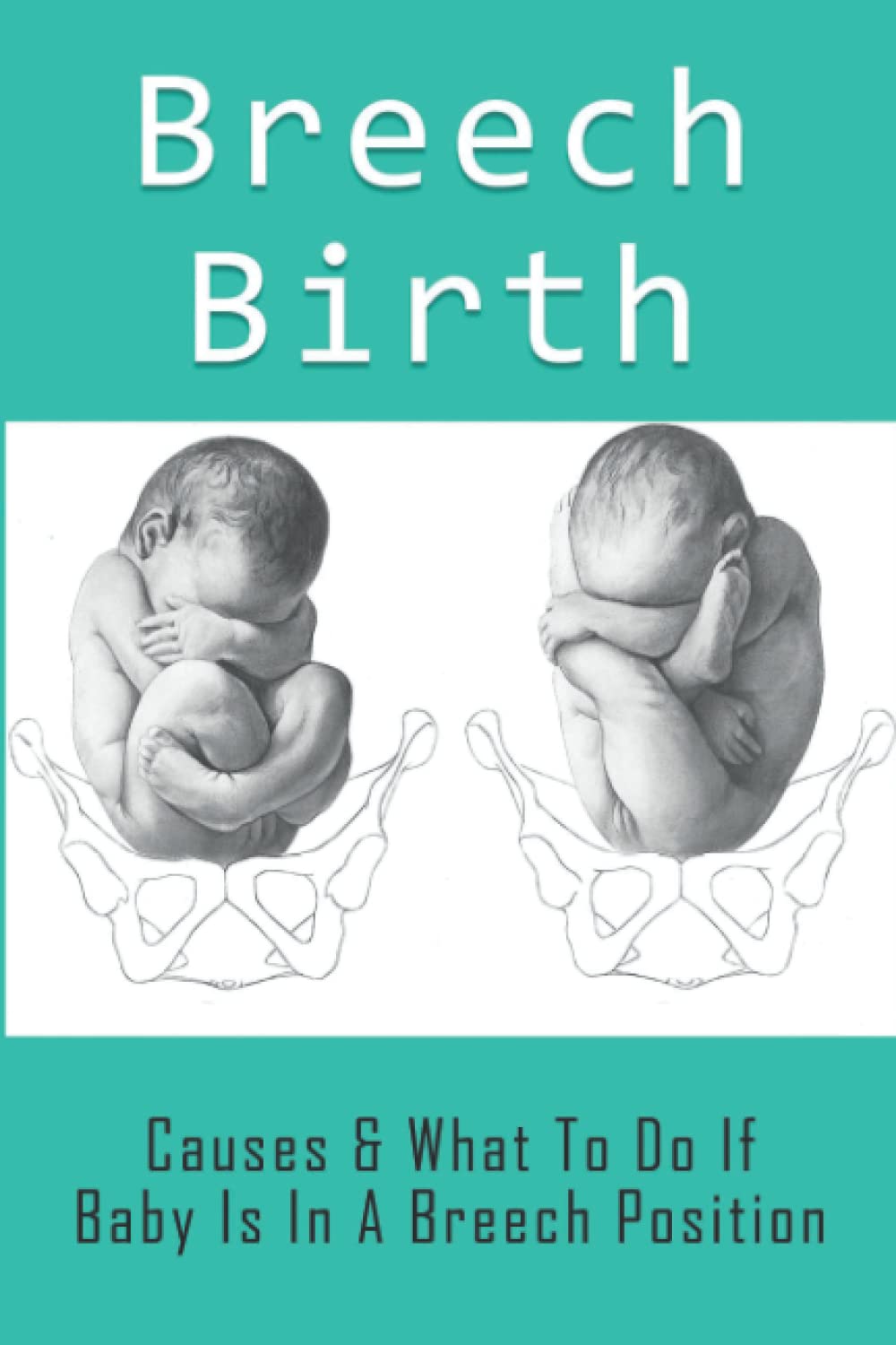 Breech Birth: Causes & What To Do If Baby Is In A Breech Position