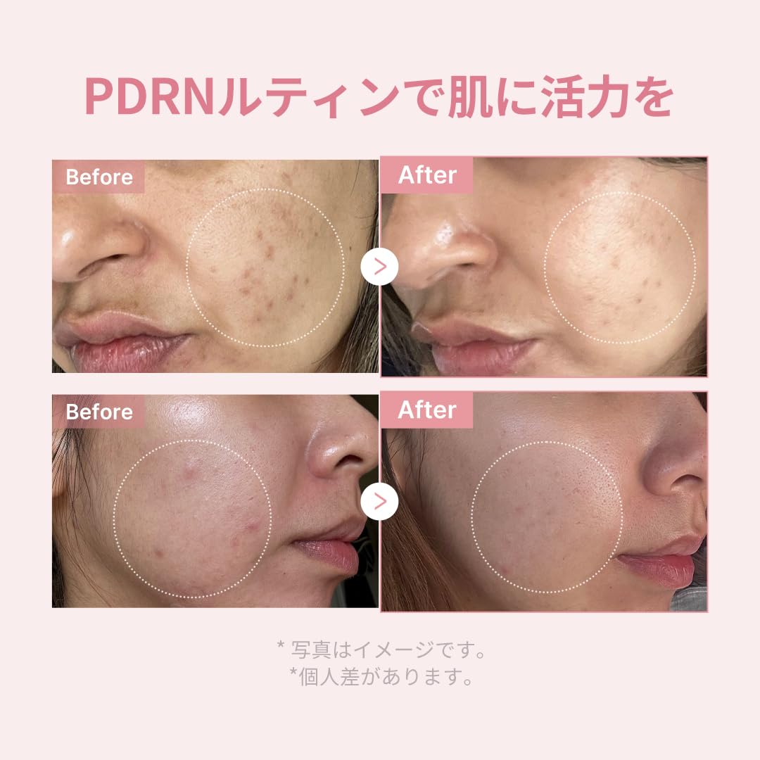 Amazon.co.jp: メディキューブ PDRNトライアルキット お試しセット