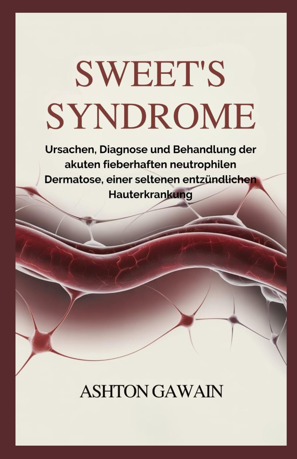 Sweet’s Syndrome: Ursachen, Diagnose und Behandlung der akuten fieberhaften neutrophilen Dermatose, einer seltenen entzündlichen Hauterkrankung