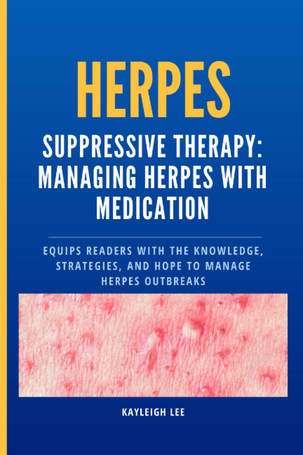 Buy HERPES Suppressive Therapy Managing Herpes with Medication Equips