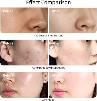 Electric Microneedle Derma Pen Auto Micro Needle Water Light Nano-introduction Injection Pen for Anti-aging Whitening Rejuvenating Acne Skin Moisturize