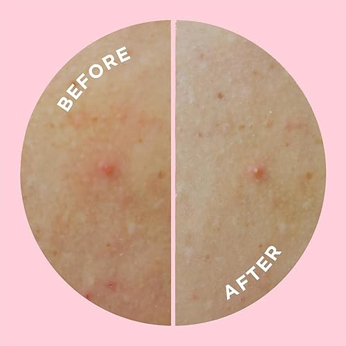 Miniatura 7 de ZitSticka Parches corporales hidrocoloides  Paquete de 9 parches clarificantes GOO GETTER para acné  Tratamiento del acné exfoliante e hidratante de