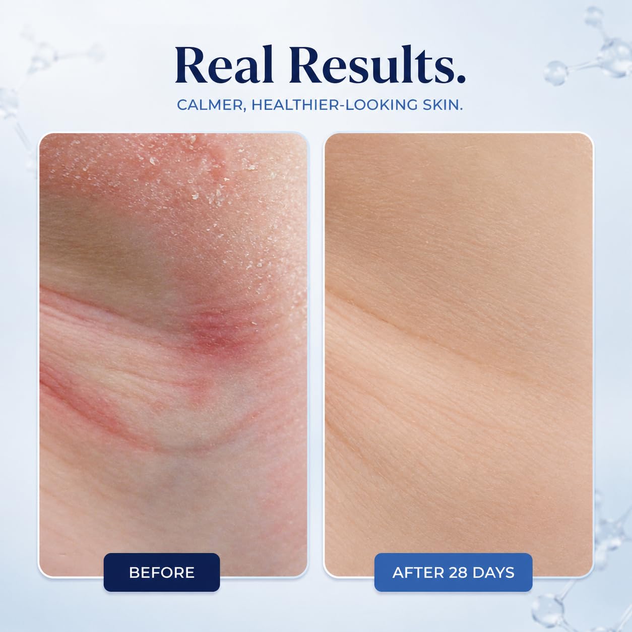 KAMEDIS Beruhigende Körpercreme für Ekzemtherapie Patentierter botanischer Komplex Klinisch bewährt für juckende, trockene und gereizte Haut. Von Dermatologen empfohlene feuchtigkeitsspendende