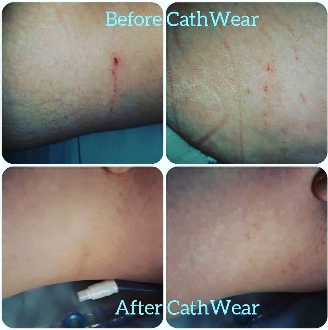 New Product Cathwear Catheter Leg Bag Underwear - Leg Bag Holder for Men & Women - Catheter Supplies Compatible with Foley, Nephrostomy, Suprapubic & Biliary Catheters Holds (2) 600ml Leg Bags - Black - X-Large Best Deal 🛒 Cathwear Catheter Leg Bag Underwear - Leg Bag Holder for Men & Women - Catheter Supplies Compatible with Foley, Nephrostomy, Suprapubic & Biliary Catheters Holds (2) 600ml Leg Bags - Black - X-Large