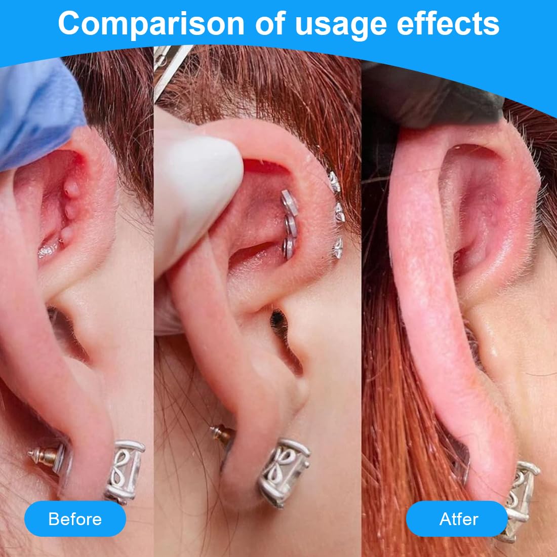 40 Pezzi Dischetti Silicone Per Piercing - 7/9mm, Trasparenti, Anti-Cheloidi, Per Orecchini E Body Piercing - Foto 4