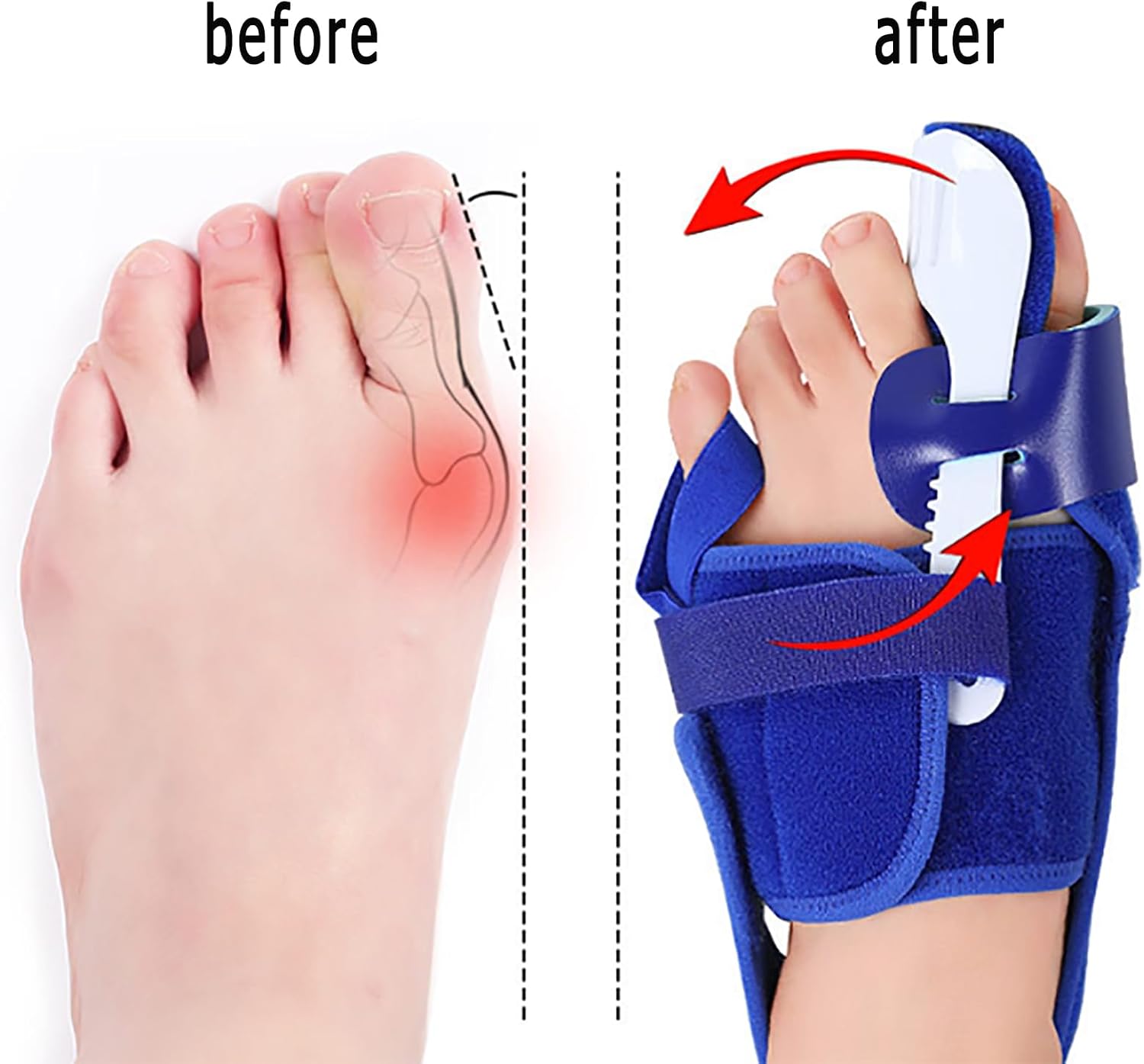 TsoLay Orthopedic Bunion Toe Straightener, Non-Slip Toe Straighteners, Adjustable Orthopedic Bunions Correction with Adjustable Strength Straps, for Day/Night Bunion Relief