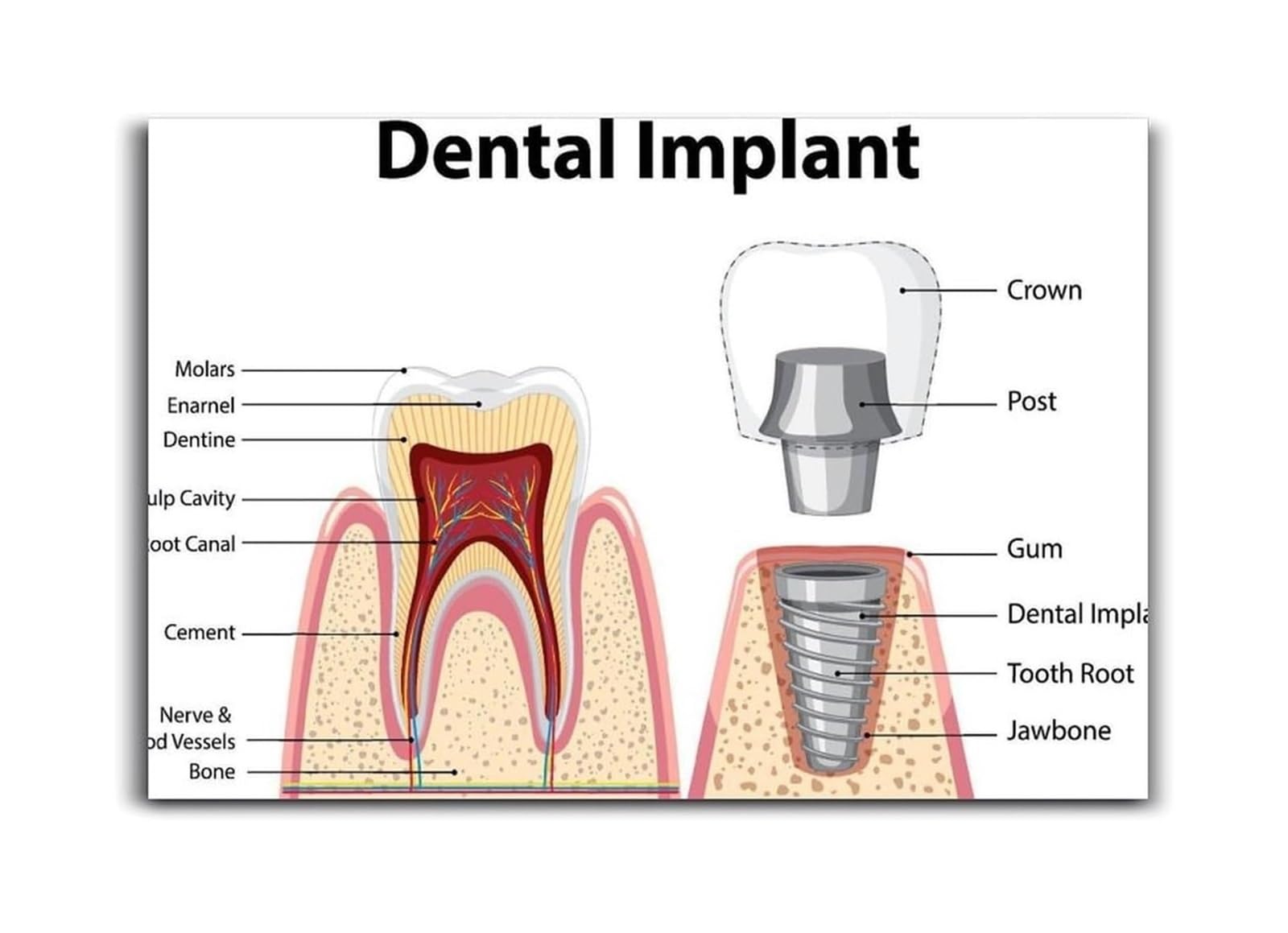 RNUMLIGH Professional Implant Anatomy Chart, Poster for Clinical Office, Teeth Replacement Surgery Diagram(Framed,12X18inch(30X45cm))