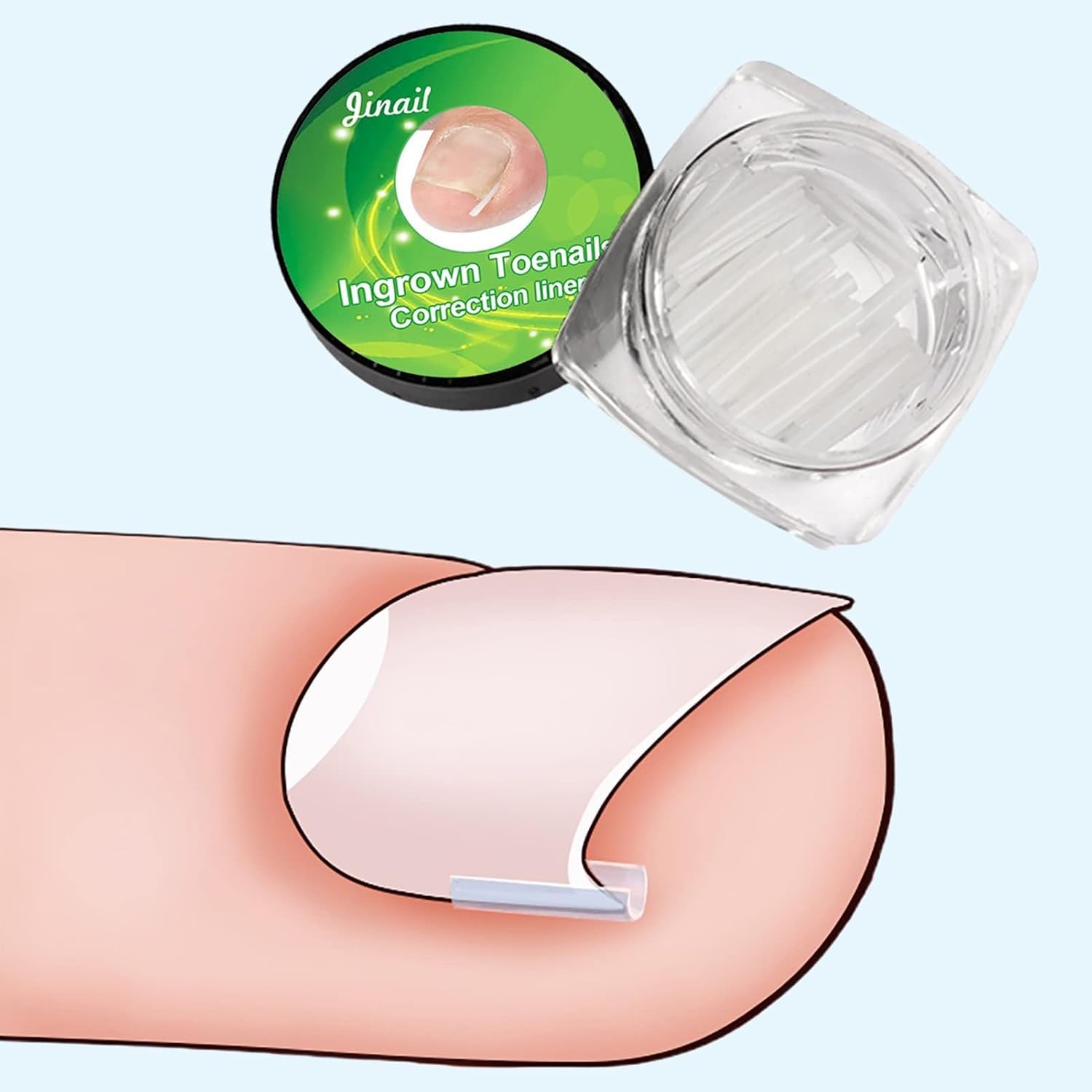 Ingrown Toenail Correction Strips Brace Kit, 10 Pcs Ingrown Toenail Corrector Straightener Strips Recover Clips Toenails Thick Pedicure Tool Strip for Men Women Foot Care Tool Pedicure Tool