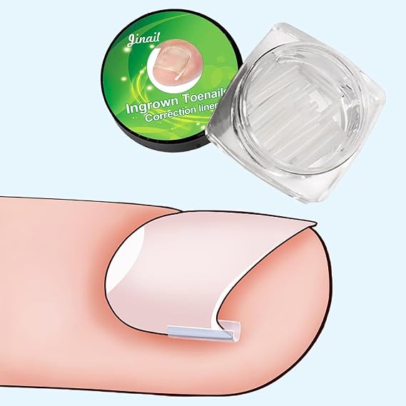 10 Pcs Ingrown Toenail Correction Strips Brace Kit, Ingrown Toenail Corrector Straightener Strips Recover Clips Toenails Thick Pedicure Tool Toenail Straightener Strip for Men Women Foot Care Tools