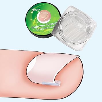 10 Pcs Ingrown Toenail Correction Strips Brace Kit, Ingrown Toenail Corrector Straightener Strips Recover Clips Toenails Thick Pedicure Tool Toenail Straightener Strip for Men Women Foot Care Tools