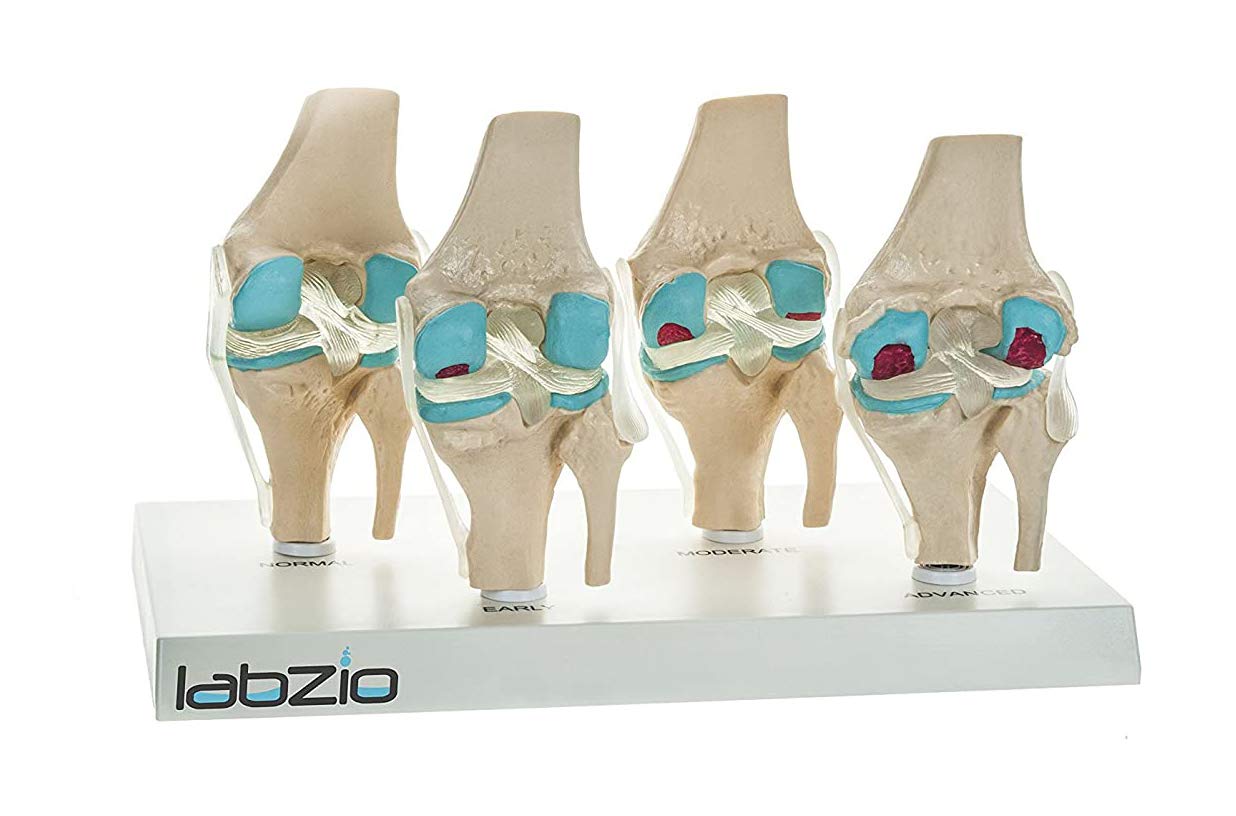 Labzio - 4 Stage Osteoarthritis Anatomical Knee Model, Model On Base, With Detailed Study Guide (B0749LJSX6) Amazon Price History, Amazon Price Tracker