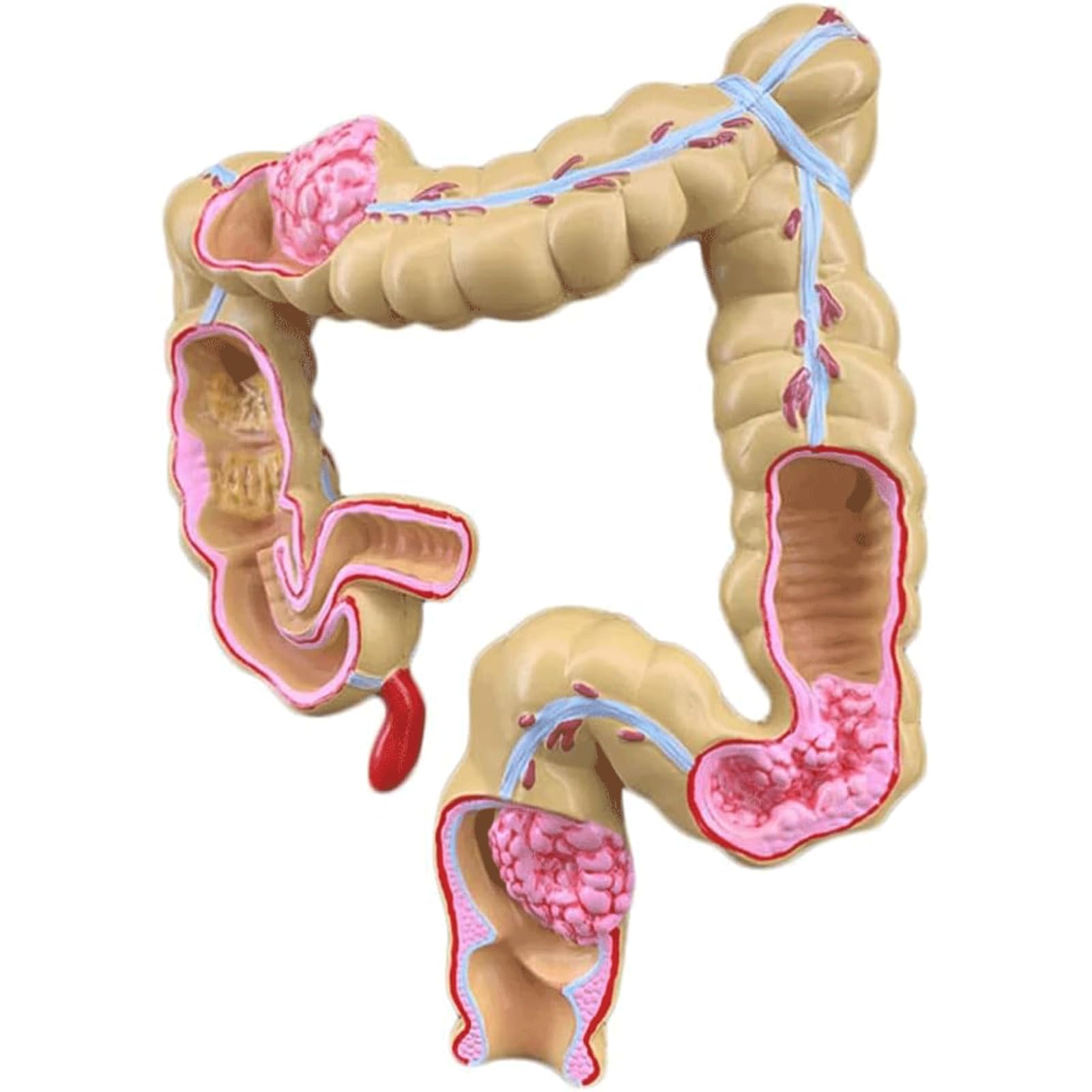 TTCHDPBX Premium Detachable Human Organ Model Human Colon Pathological Model Internal Organ Anatomy Model for Educational Training Aid Experience Real Anatomy