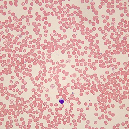 Human Sickle Cell Anemia Slide, Smear, Wright's Stain
