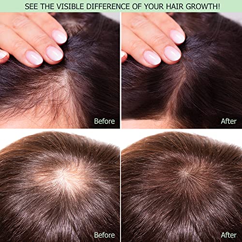 Rice Water For Hair Growth, Leave In Rice Water Hair Care Products For Women & Men, Biotin Infused Fermented Rice Water Spray. Rice Water Hair Mist For Dry, Frizzy, Weak, Damaged Hair - Strengthen, Moisturize & Thicken Hair Naturally - 4Oz #TOP2