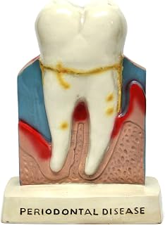 Dental Molar Oral Anatomy Teaching Standing Decoration Model Figure; Shows Periodontal Disease and Gingivitis - Vintage Look Yet Item is New.