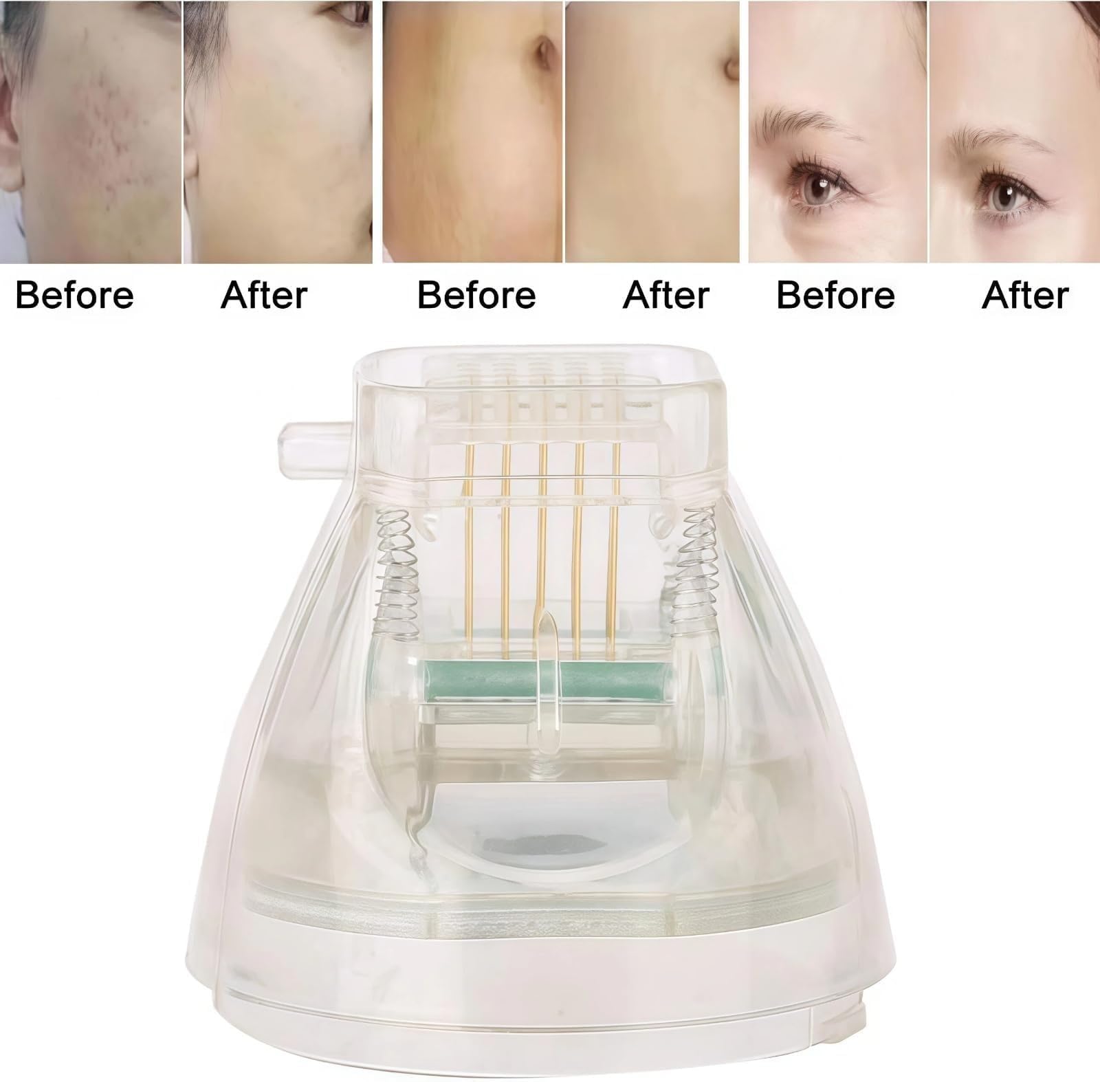 Reemplazo Desechable Rejilla De Circuito En Forma De Flor Punta De Reemplazo Para Dispositivo De Belleza RF Pack De 5pcs-25 pin