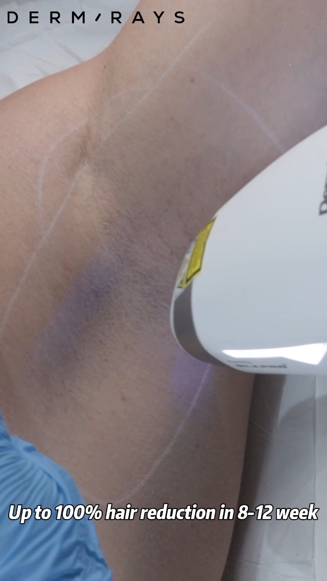 Amazon.com: DermRays Laser Hair Removal for Women and Men, V4S for