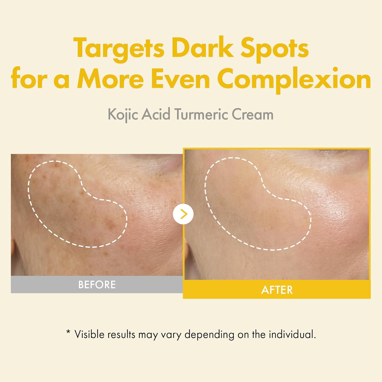 TOSOWOONG Kojic Acid Turmeric Cream, 99% Purity Kojic Acid 7,000ppm, 660,941ppm Turmeric, Dark Spot Corrector Capsule for Hyperpigmentation & Even Skin Tone Care, Korean Skincare, 50ml / 1.69 fl. oz. - Image 2