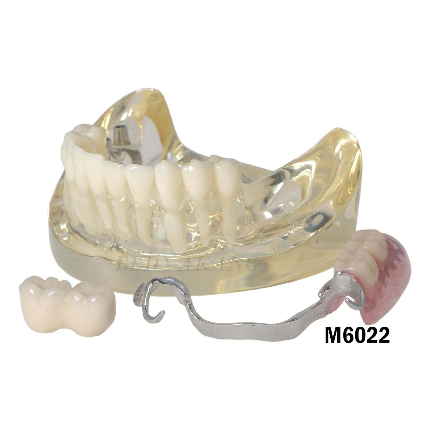 Dental RPD Removable Partial dentures Model Typodont Philippines | Ubuy