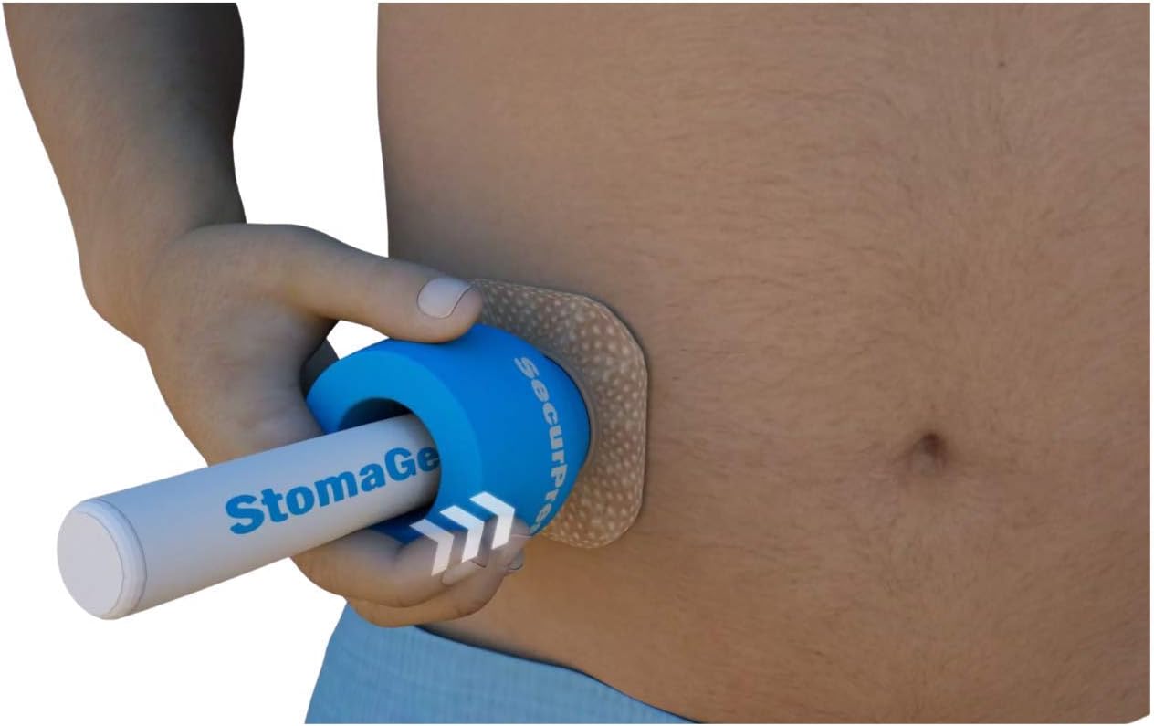 SECURPRESS Stoma Secure Device - 1-Pack - (1 1/2"), for Any Type of Ileostomy, Urostomy, Colostomy Stoma Pouch/Base Plate Change, Skin Protection, and Leakage Prevention.