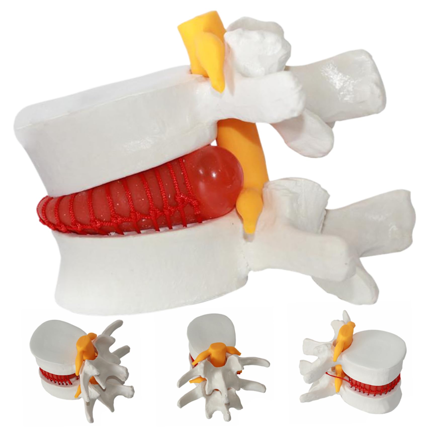 Material didáctico para aliviar la hernia de disco, modelo de cuerpo humano de PVC de vértebra lumbar herniada, modelo de columna lumbar de tamaño natural 1, 5 veces para enseñar, aprender y demo