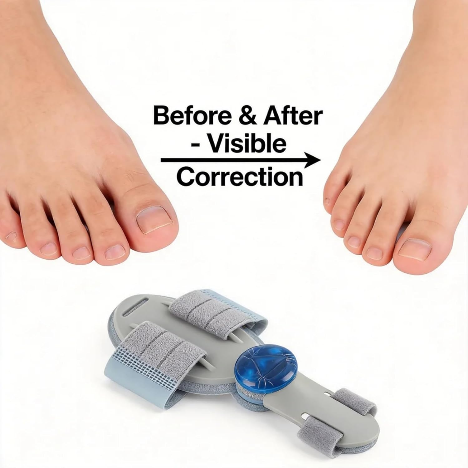Align Toe Pro Fix for Women Men Big Toe Straightener Bunion Fix with Adjustable Knob, Recovio Health AlignToe Pro (2 PCS)