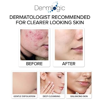 Acne Treatment Pads- Contains Salicylic, Glycolic, Lactic Acid for Face & Body. Clears Away Clogged Pores, Oily Skin & Cystic Breakouts. Removes Dark Spots, Blackhead & Whitehead Pimples