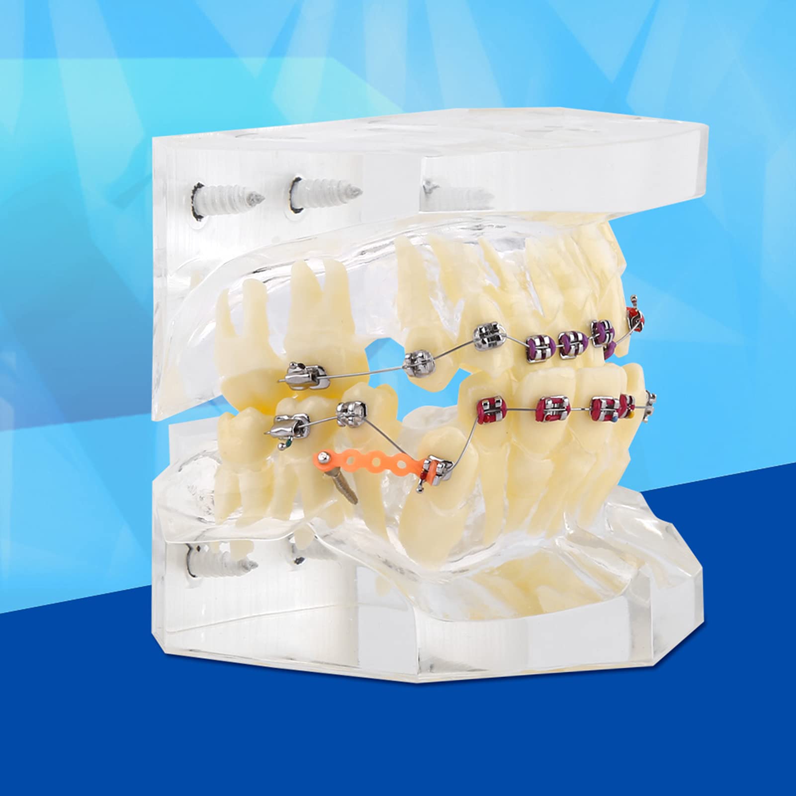 Staffe Ortodontiche, Modello di Denti Trattamento Ortodontico Dentale Studio di Malocclusione Modello di Denti con Staffe Dentali a Catena Metallica