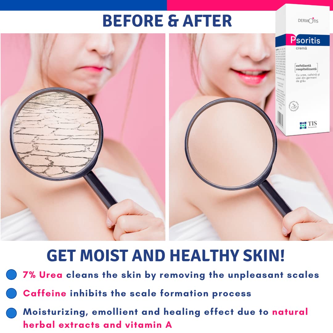 TIS Crema Urea 7%, per Eczemi, Pelle sogeto a Psoriasi, Cheratosi - Guarigione Delle Ferite - Pelle Secca, Screpolata e Ruvida - Mani, Piedi, Unghie, Gomiti, Ginocchia - Caffeina, Vit A