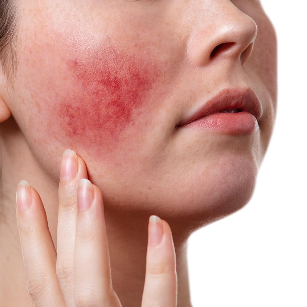 Rosacea Treatment & Symptoms | Request prescription for rosacea medication for face redness like metronidazole cream, ivermectin (Soolantra), brimonidine from an online doctor, NP, or PA