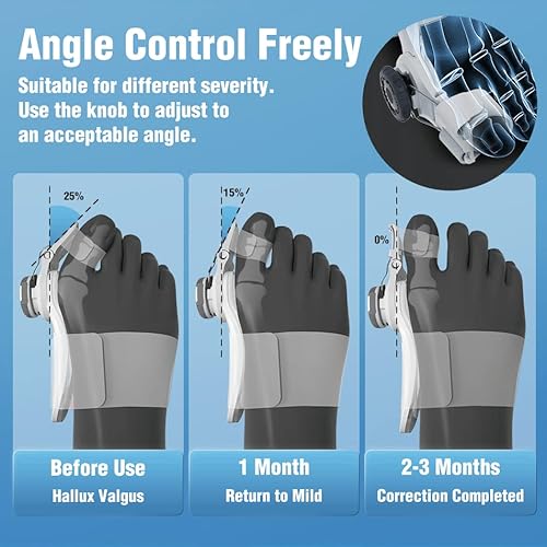 Tech Love Bunion Corrector For Women And Men, Orthopedic Bunion Toe Straightener, Adjustable Bunion Splint With Toe Separator For Bunion Relief, Day Night Support(1Pc) #TOP1