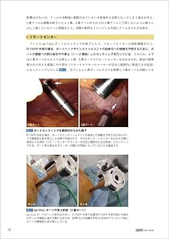 ロボット支援鼠径部ヘルニア修復術入門 安全な導入から手術手順