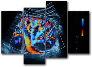UJOYAFZSIM Kidney ultrasound with Doppler effect Canvas Wall Art Framed Artwork Prints Painting Modern Gallery Posters for Living Room Bedroom Office Home Decoration 4 piece