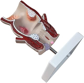 Organ Model Science Rectum Fissure Lesion Model - Rectum Fissure Lesion Model - Human Anatomy - 5X Human Anorectal Pathology Model Hemorrhoid Anal Fistula Anatomical Model